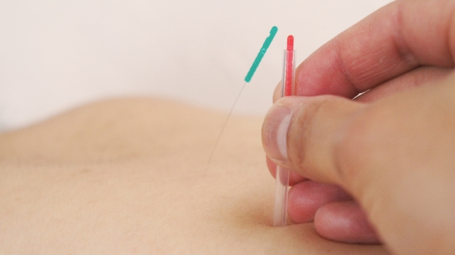 鍼治療 Acupuncture