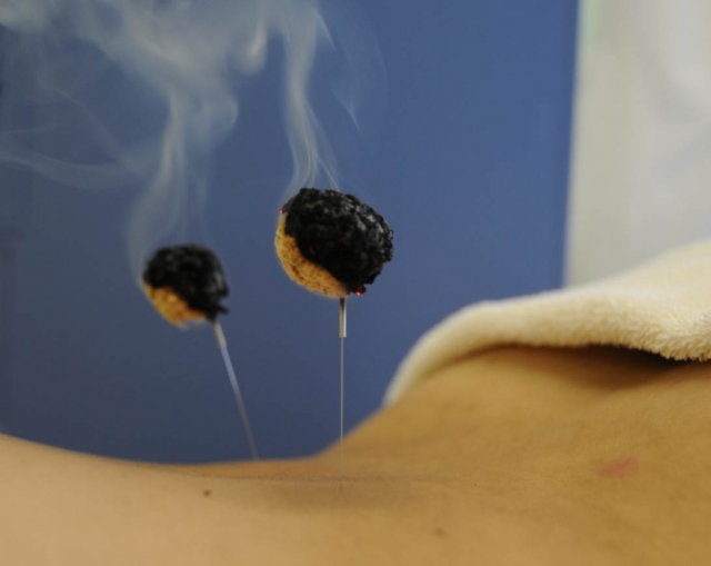 お灸のご紹介。灸（きゅう）とは？どのような効果があるのか？（治療